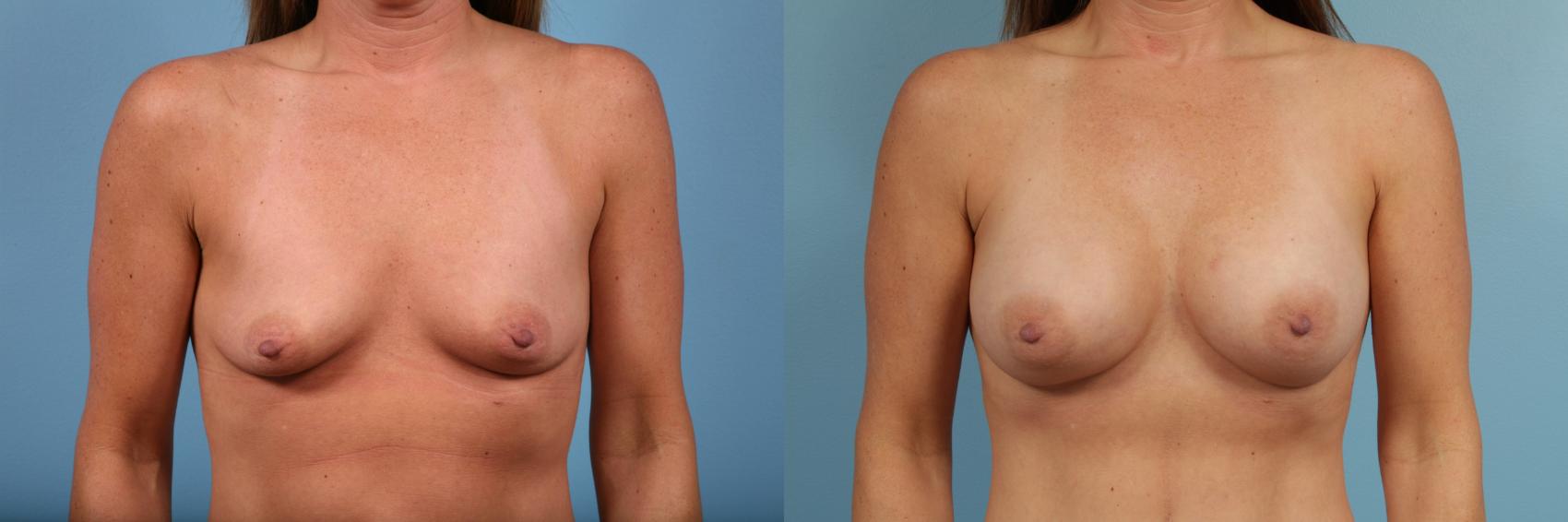Before & After Breast Augmentation by Dr. Mustoe Case 102 Front View in Chicago, IL