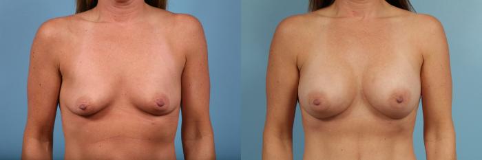 Before & After Breast Augmentation by Dr. Mustoe Case 102 Front View in Chicago, IL