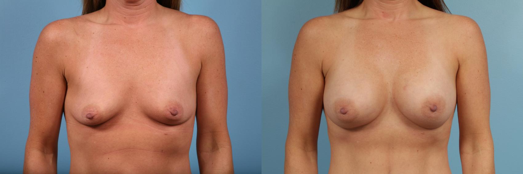 Before & After Breast Augmentation by Dr. Mustoe Case 102 View #1 View in Chicago, IL