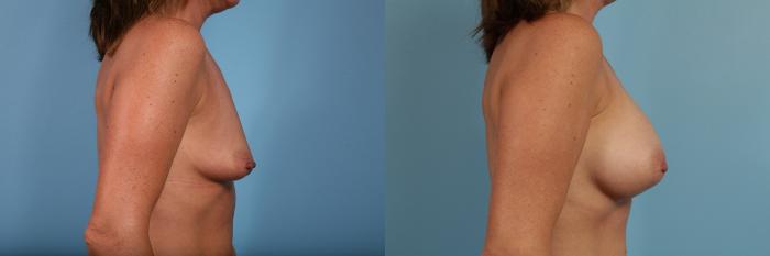 Before & After Breast Augmentation by Dr. Mustoe Case 102 View #3 View in Chicago, IL