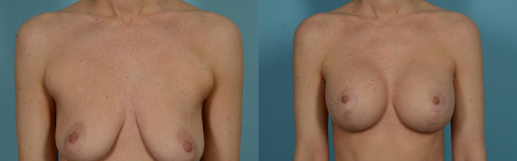 Before & After Breast Augmentation by Dr. Mustoe Case 1032 Front View in Chicago, IL