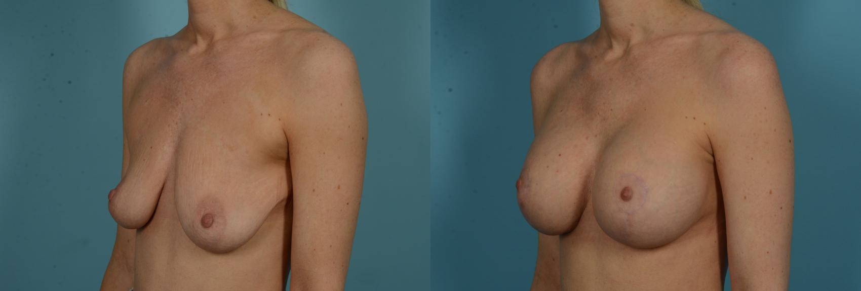 Before & After Breast Lift Case 1032 Left Oblique View in Chicago, IL