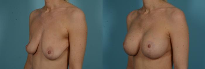 Before & After Breast Augmentation by Dr. Mustoe Case 1032 Left Oblique View in Chicago, IL