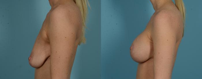 Before & After Breast Augmentation by Dr. Mustoe Case 1032 Left Side View in Chicago, IL