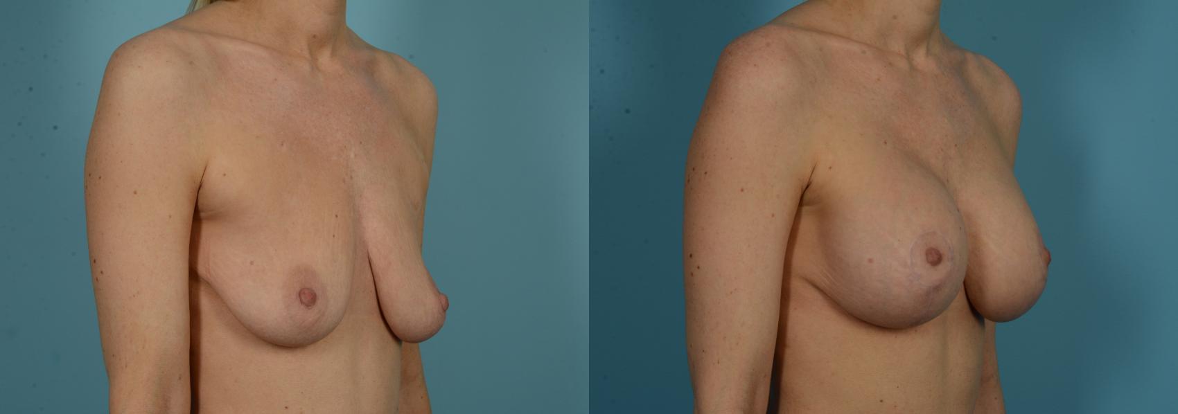 Before & After Breast Lift Case 1032 Right Oblique View in Chicago, IL