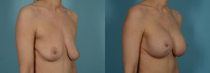 Before & After Breast Augmentation by Dr. Mustoe Case 1032 Right Oblique View in Chicago, IL