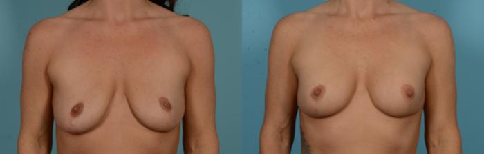 Before & After Breast Augmentation by Dr. Mustoe Case 1091 Front View in Chicago, IL