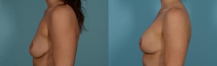 Before & After Breast Augmentation by Dr. Mustoe Case 1091 Left Side View in Chicago, IL