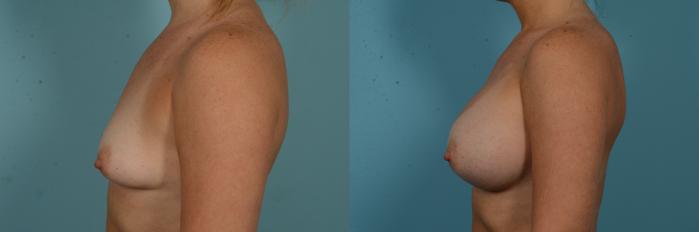 Before & After Breast Augmentation by Dr. Mustoe Case 1103 Left Side View in Chicago, IL