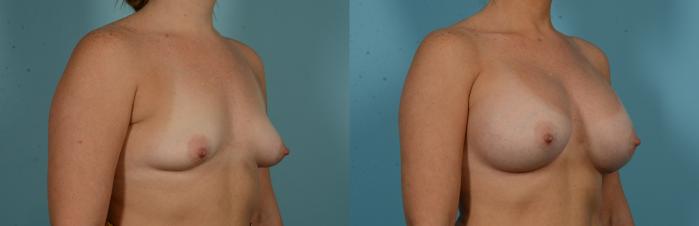Before & After Breast Augmentation by Dr. Mustoe Case 1103 Right Oblique View in Chicago, IL
