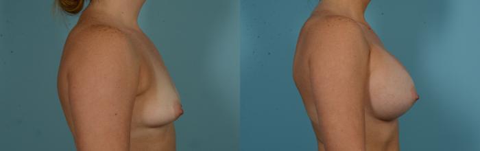 Before & After Breast Augmentation by Dr. Mustoe Case 1103 Right Side View in Chicago, IL