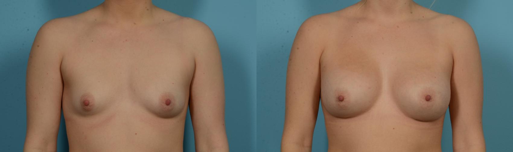 Before & After Breast Augmentation by Dr. Mustoe Case 1105 Front View in Chicago, IL