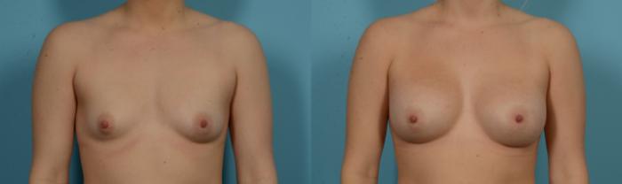 Before & After Breast Augmentation by Dr. Mustoe Case 1105 Front View in Chicago, IL