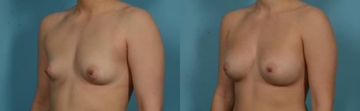 Before & After Breast Augmentation by Dr. Mustoe Case 1105 Left Oblique View in Chicago, IL