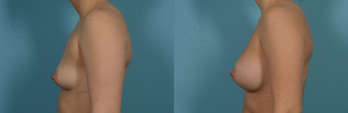 Before & After Breast Augmentation by Dr. Mustoe Case 1105 Left Side View in Chicago, IL