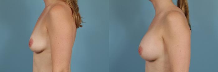 Before & After Breast Augmentation by Dr. Mustoe Case 204 View #2 View in Chicago, IL