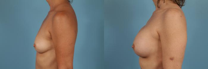 Before & After Breast Augmentation by Dr. Mustoe Case 207 View #2 View in Chicago, IL