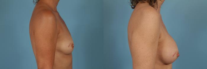 Before & After Breast Augmentation by Dr. Mustoe Case 207 View #3 View in Chicago, IL