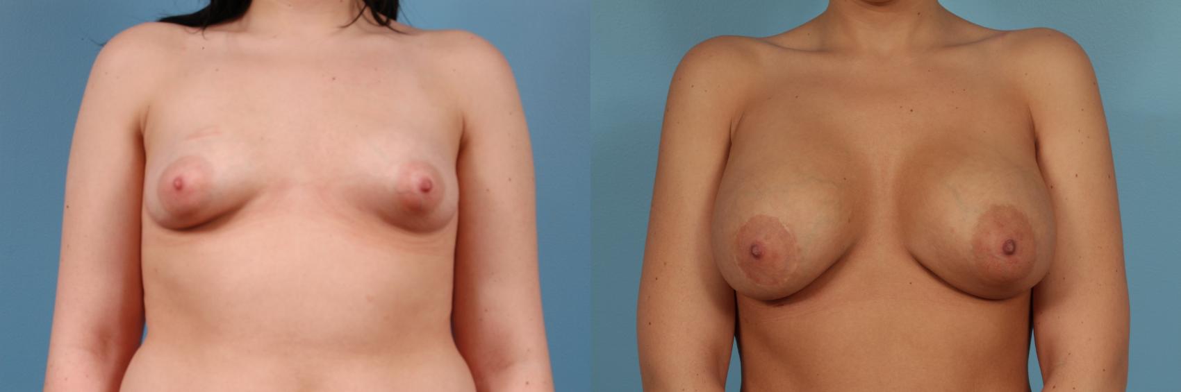 Before & After Breast Augmentation by Dr. Mustoe Case 230 Front View in Chicago, IL