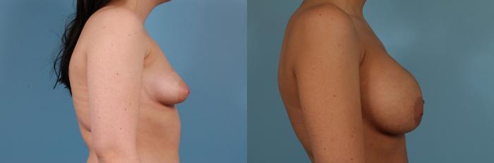 Before & After Breast Augmentation by Dr. Mustoe Case 230 Right Side View in Chicago, IL