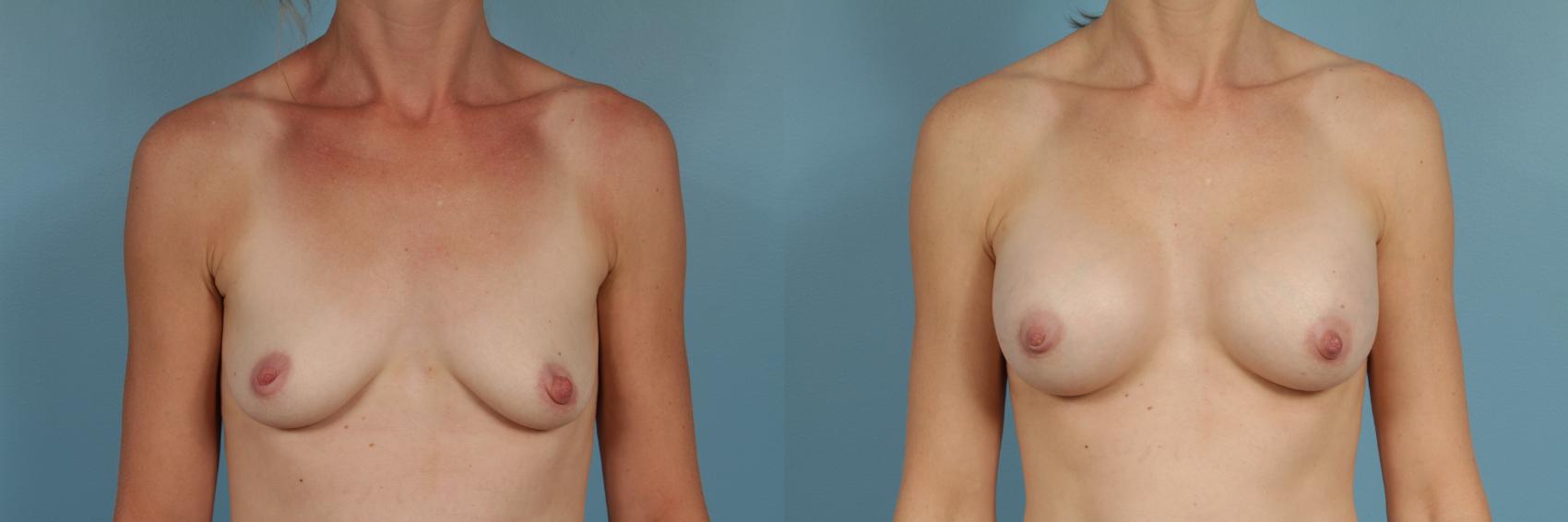 Before & After Breast Augmentation by Dr. Mustoe Case 262 View #1 View in Chicago, IL