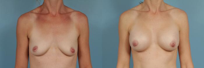 Before & After Breast Augmentation by Dr. Mustoe Case 262 View #1 View in Chicago, IL