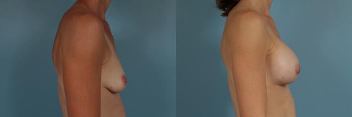 Before & After Breast Augmentation by Dr. Mustoe Case 262 View #3 View in Chicago, IL