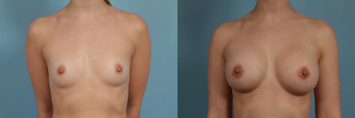 Before & After Breast Augmentation by Dr. Mustoe Case 273 View #1 View in Chicago, IL