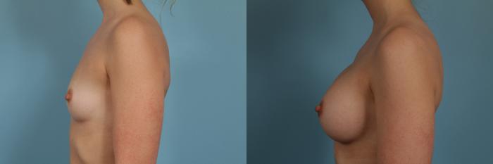 Before & After Breast Augmentation by Dr. Mustoe Case 273 View #2 View in Chicago, IL