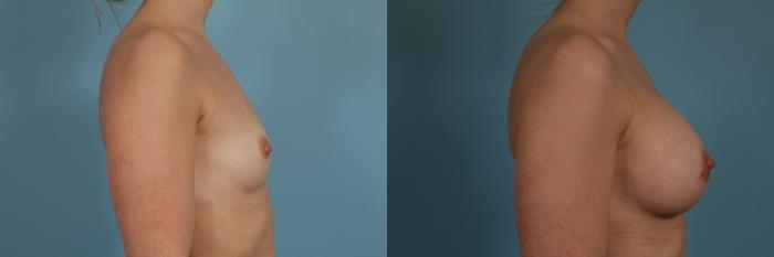 Before & After Breast Augmentation by Dr. Mustoe Case 273 View #3 View in Chicago, IL