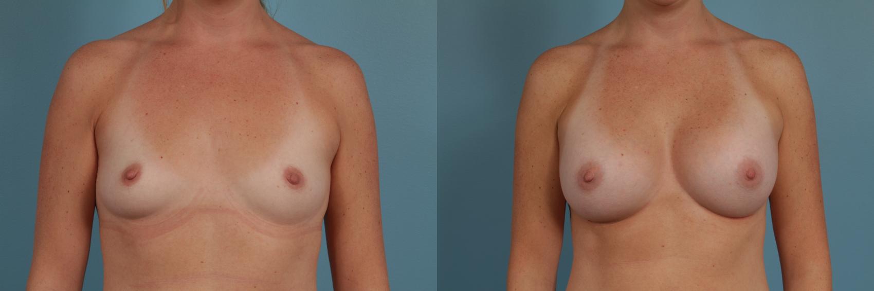 Before & After Breast Augmentation by Dr. Mustoe Case 277 View #1 View in Chicago, IL