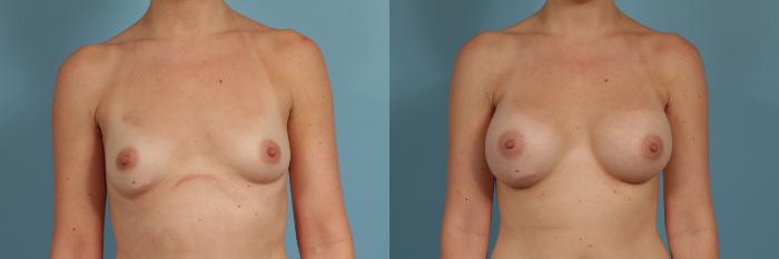 Before & After Breast Augmentation by Dr. Mustoe Case 300 View #1 View in Chicago, IL