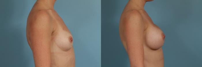 Before & After Breast Augmentation by Dr. Mustoe Case 300 View #3 View in Chicago, IL