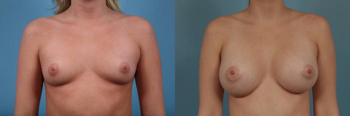 Before & After Breast Augmentation by Dr. Mustoe Case 322 View #1 View in Chicago, IL