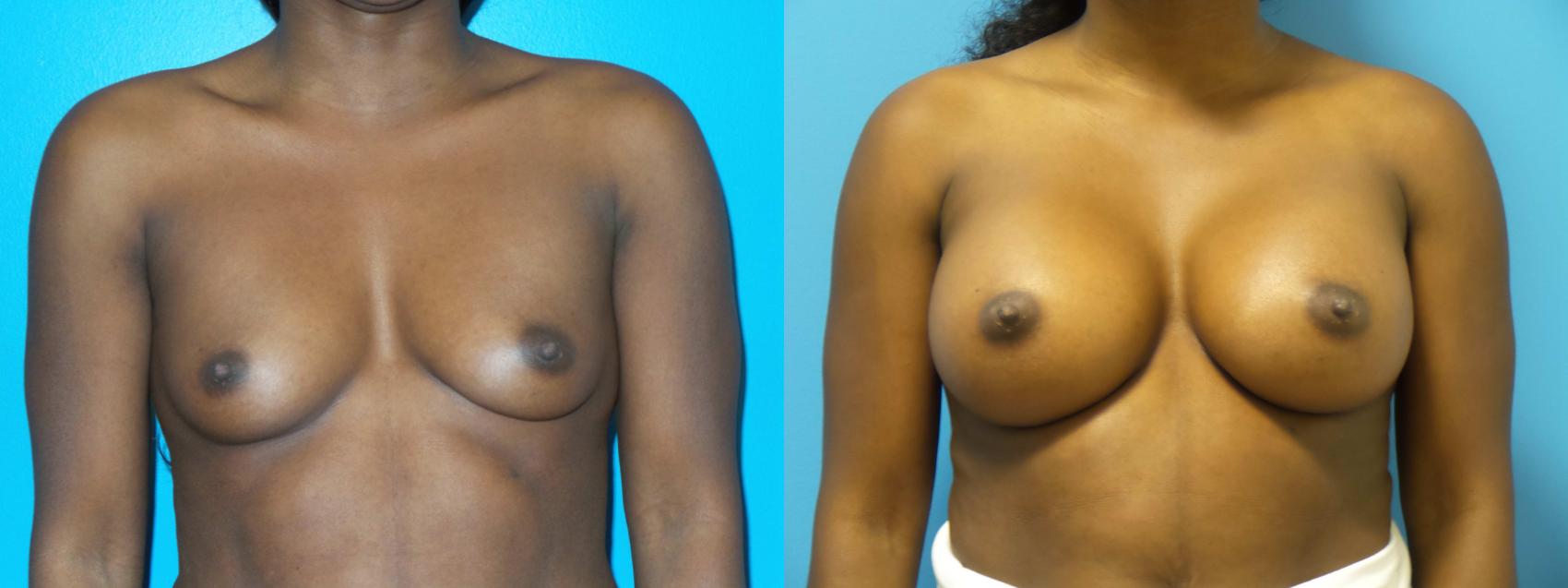 Before & After Breast Augmentation by Dr. Mustoe Case 429 Front View in Chicago, IL