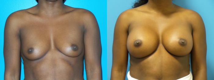 Before & After Breast Augmentation by Dr. Mustoe Case 429 Front View in Chicago, IL