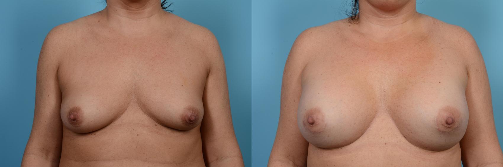 Before & After Breast Augmentation by Dr. Mustoe Case 474 View #1 View in Chicago, IL