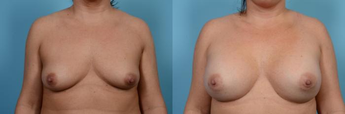 Before & After Breast Augmentation by Dr. Mustoe Case 474 View #1 View in Chicago, IL