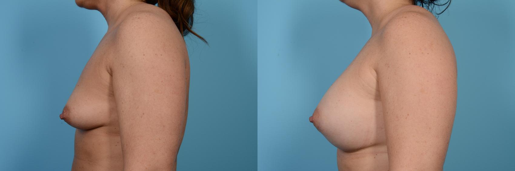 Before & After Breast Augmentation by Dr. Mustoe Case 474 View #2 View in Chicago, IL