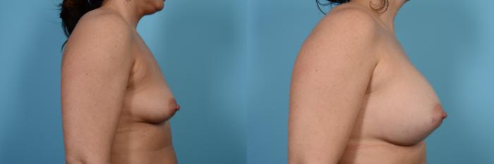 Before & After Breast Augmentation by Dr. Mustoe Case 474 View #3 View in Chicago, IL