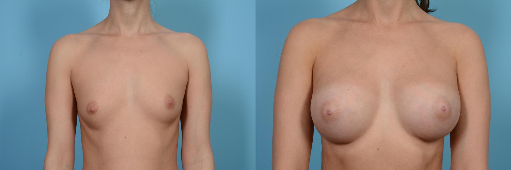 Before & After Breast Augmentation by Dr. Mustoe Case 477 View #1 View in Chicago, IL