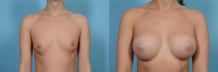 Before & After Breast Augmentation by Dr. Mustoe Case 477 View #1 View in Chicago, IL