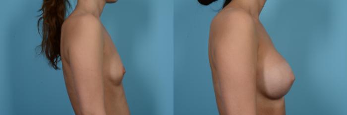 Before & After Breast Augmentation by Dr. Mustoe Case 477 View #3 View in Chicago, IL