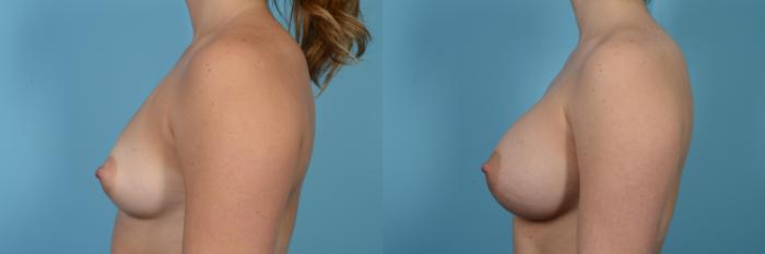 Before & After Breast Augmentation by Dr. Mustoe Case 483 View #2 View in Chicago, IL