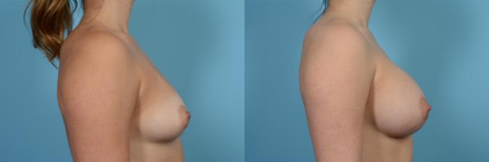 Before & After Breast Augmentation by Dr. Mustoe Case 483 View #3 View in Chicago, IL