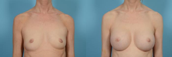 Before & After Breast Augmentation by Dr. Mustoe Case 497 View #1 View in Chicago, IL