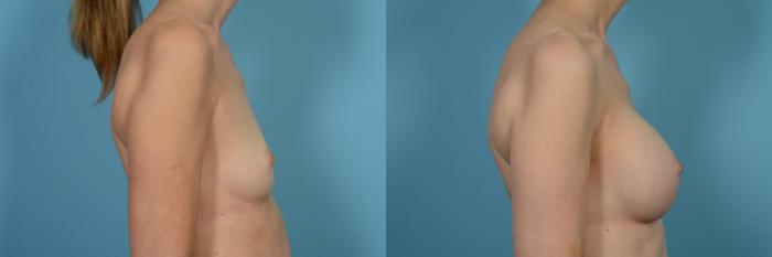 Before & After Breast Augmentation by Dr. Mustoe Case 497 View #2 View in Chicago, IL