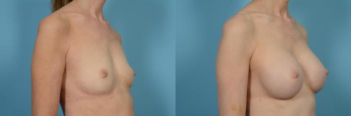 Before & After Breast Augmentation by Dr. Mustoe Case 497 View #4 View in Chicago, IL