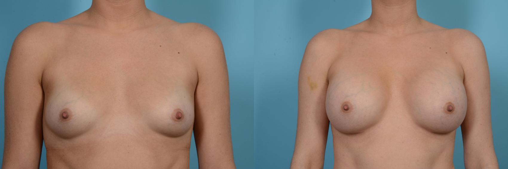 Before & After Breast Augmentation by Dr. Mustoe Case 512 View #1 View in Chicago, IL