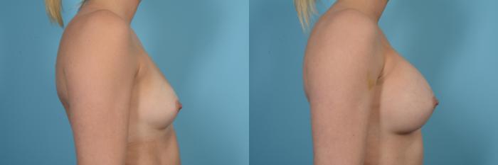 Before & After Breast Augmentation by Dr. Mustoe Case 512 View #3 View in Chicago, IL